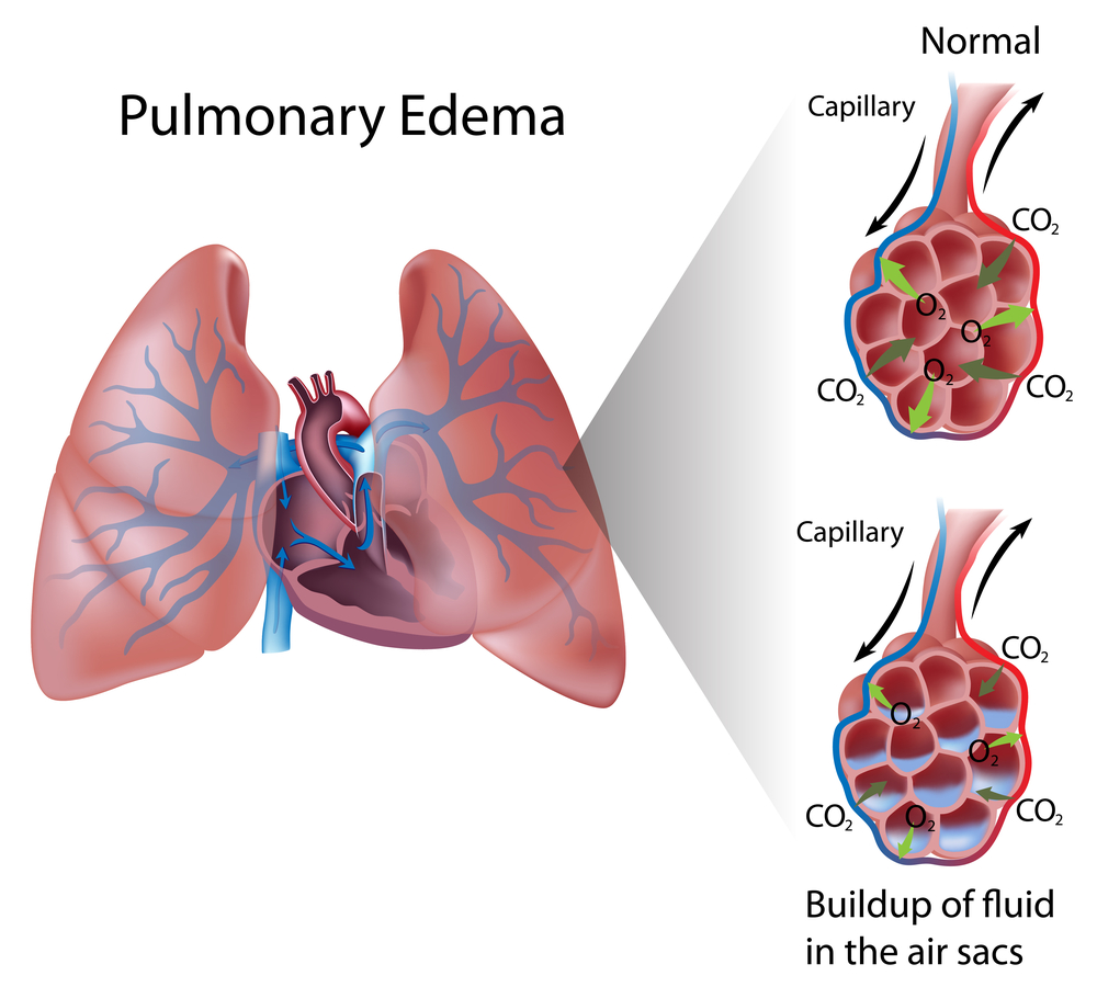 lungs-rlife-lunges-chronic-cough-mucus