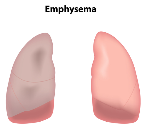 Emphysema