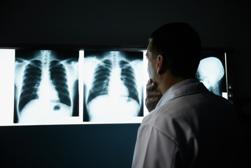 Memorial Hermann Starts New Lung Cancer Screening Program For At-Risk Patients