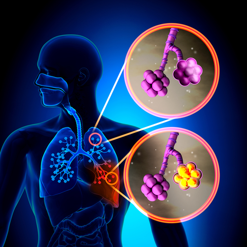 COPD Patients Differentially Affected by Pneumonia