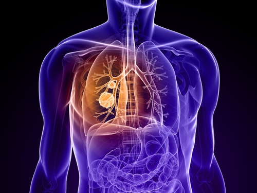 Stereotactic Body Radiotherapy Now Considered Standard Care For Inoperable Patients With Early Stage Lung Cancer