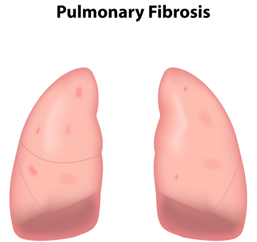 Generation of iPSC Suggests New Idiopathic Pulmonary Fibrosis Stem Cell Treatment