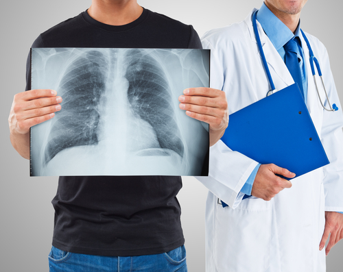 Cryobiopsy May Offer Diagnostic Value For Idiopathic Pulmonary Fibrosis, Other Lung Diseases