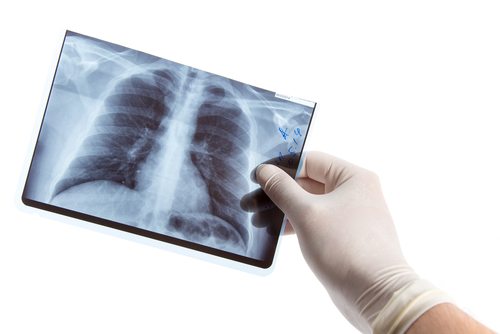 Acute Idiopathic Pulmonary Fibrosis Exacerbations Difficult To Diagnose, Says Study