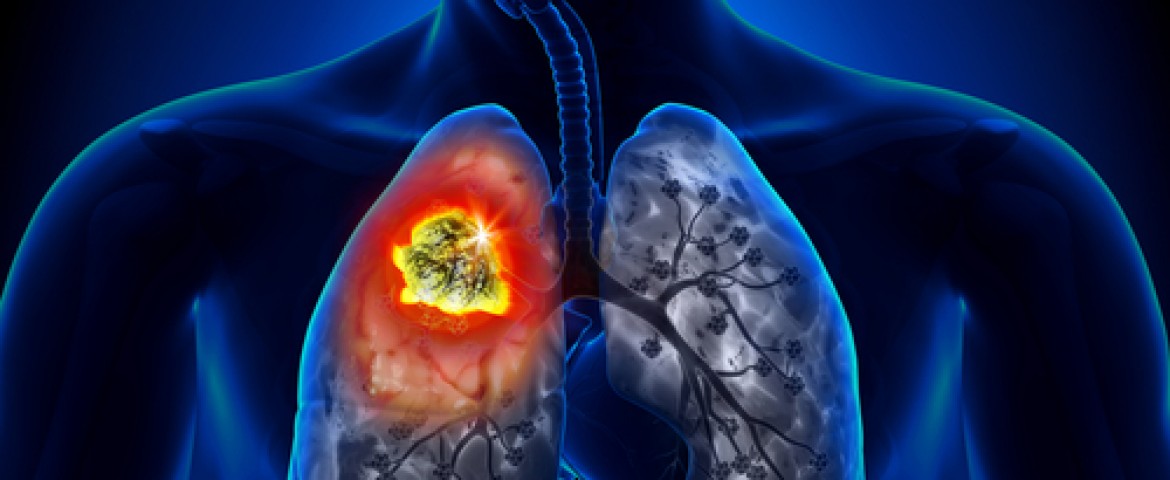 CDC Report Reveals Lung Cancer Ranks Third Most Common