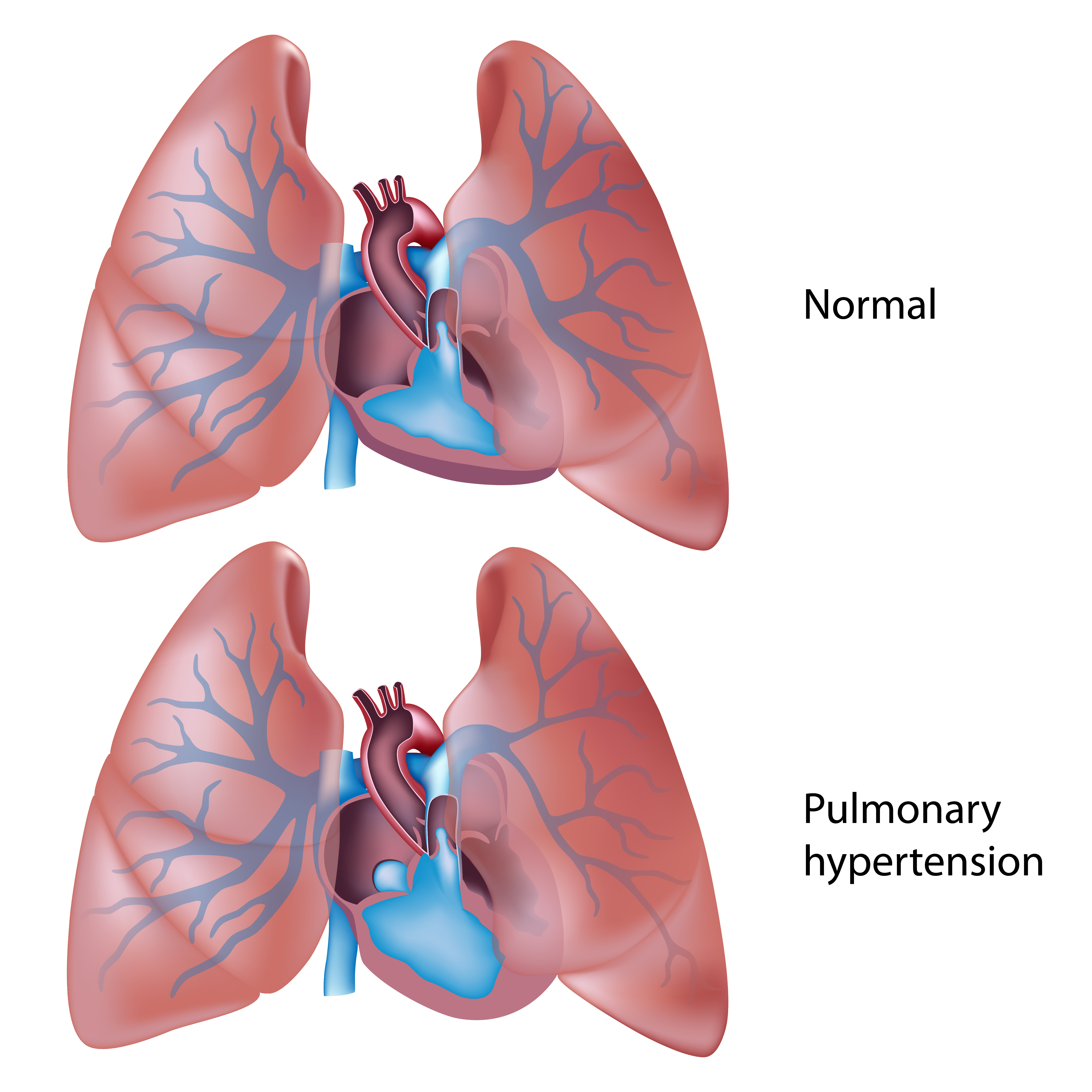 Children With Pulmonary Hypertension Still A Major Risk Group For 