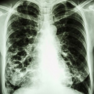 An X-ray of Bronchiectasis