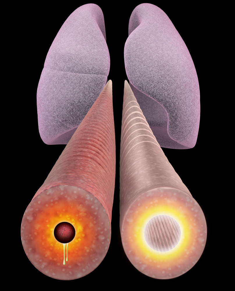 copd inflammation