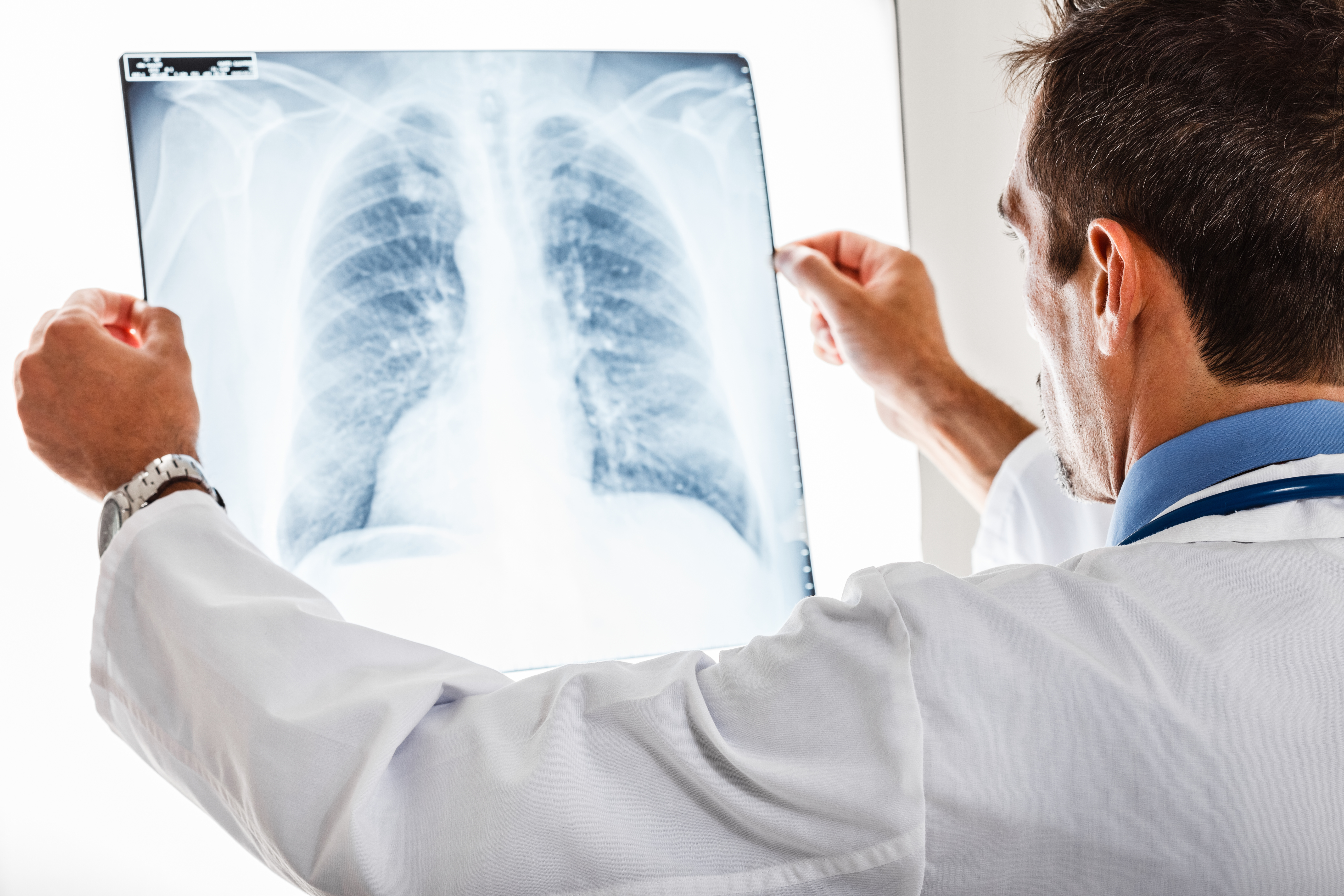 Comorbidities Found To Decrease Survival in Lung Cancer Patients
