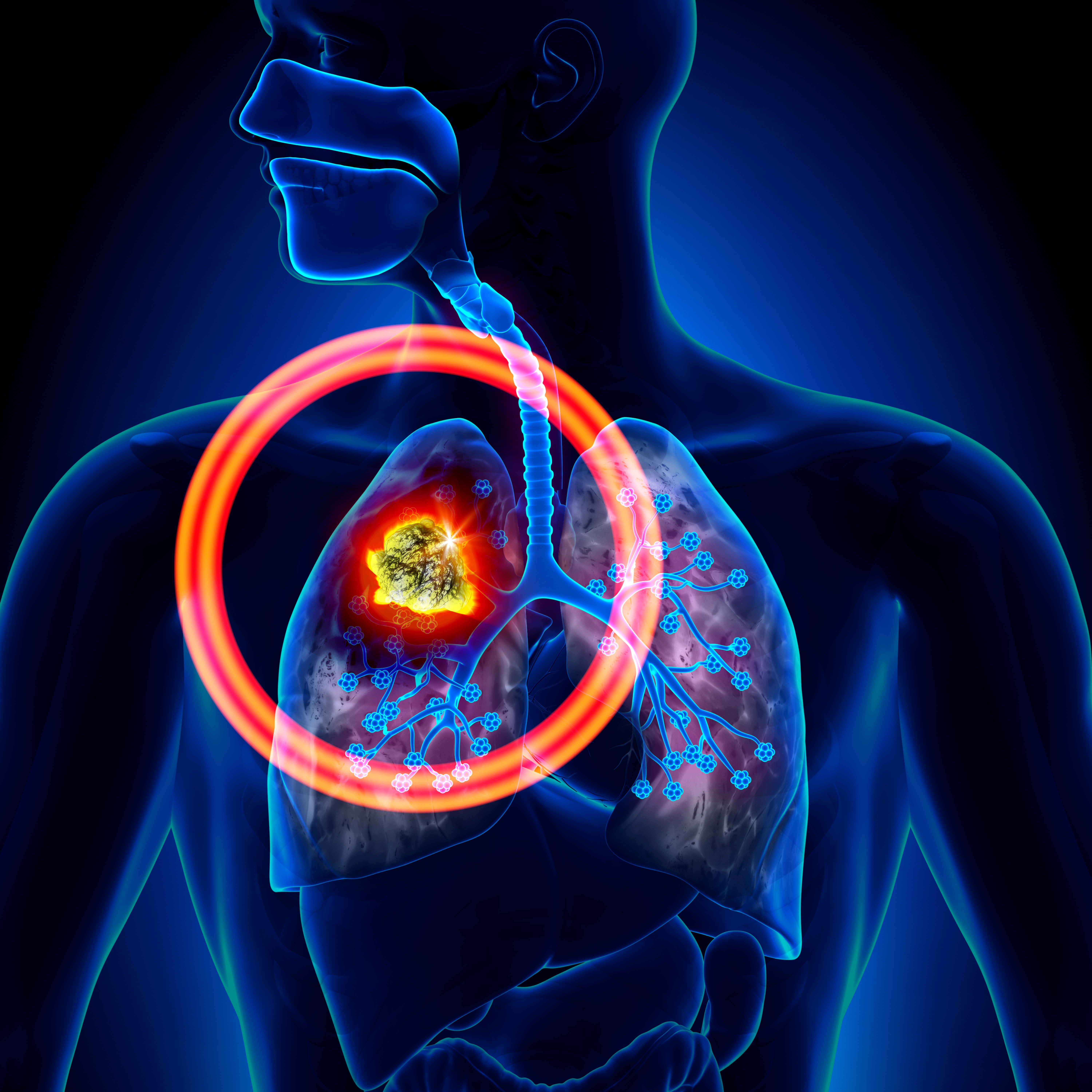 Positron Emission Tomography Cancer