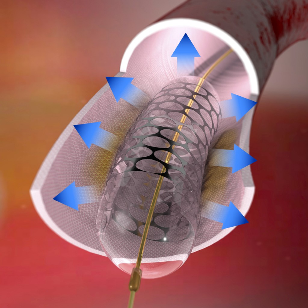 pulmonary-artery-denervation-found-to-improve-idiopathic-pah-patients