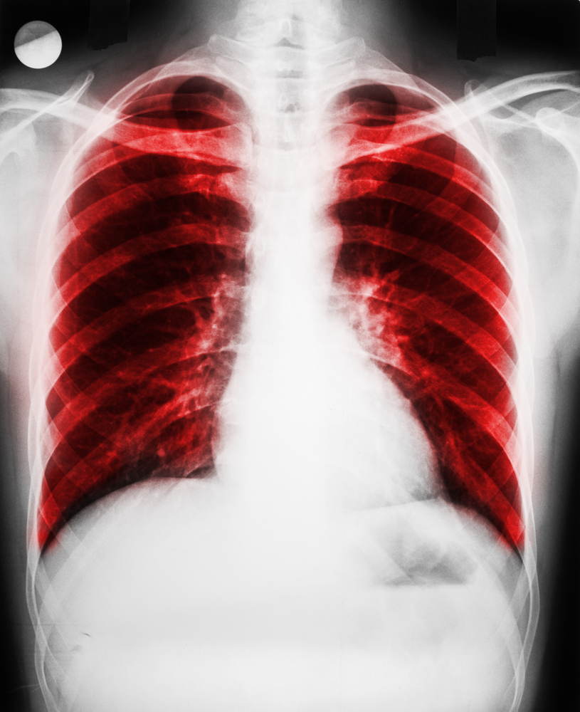 Pulmonary Fibrosis Can Be Treated by Targeting TGF-beta, Study Shows