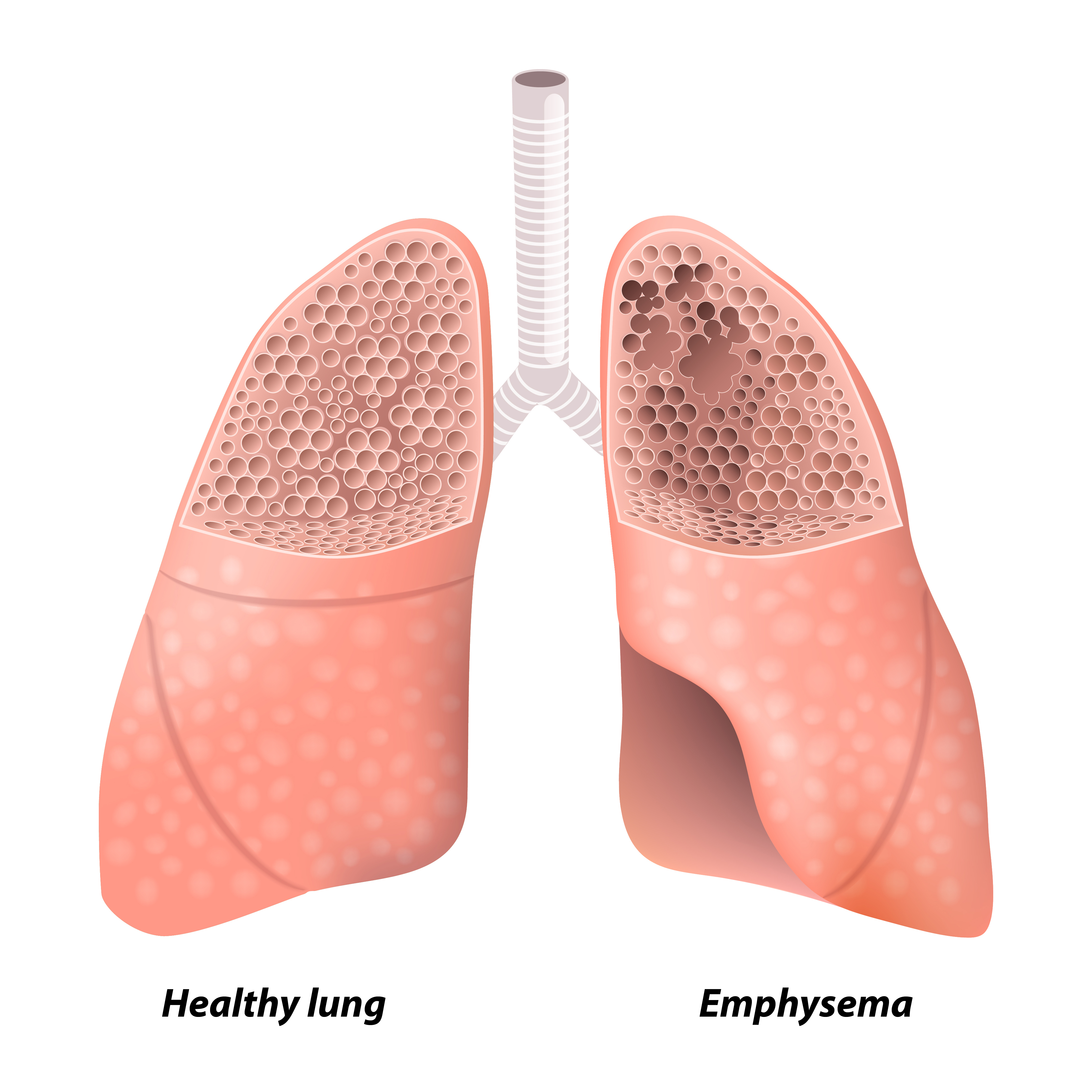 Lung Diseases Found To Be Primarily Linked To Defects In Stem Cells And 