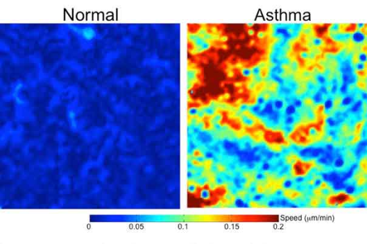 Harvard Scientists Find Asthma Cells Scrambling Like There’s A Fire Drill
