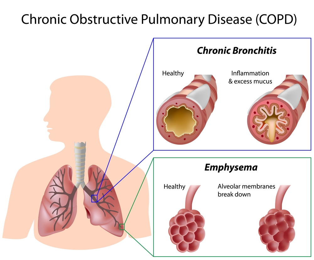 Aclidinium/formoterol Therapy Reduces COPD Patients’ Exacerbations