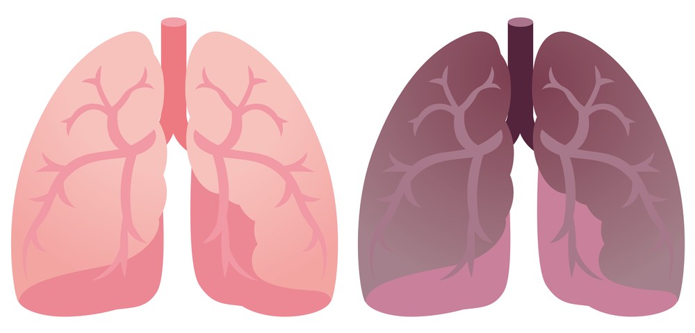 Regardless of IPF Diagnosis, Acute Respiratory Worsening Is an Independent Factor That Increases Morbidity, Study Suggests