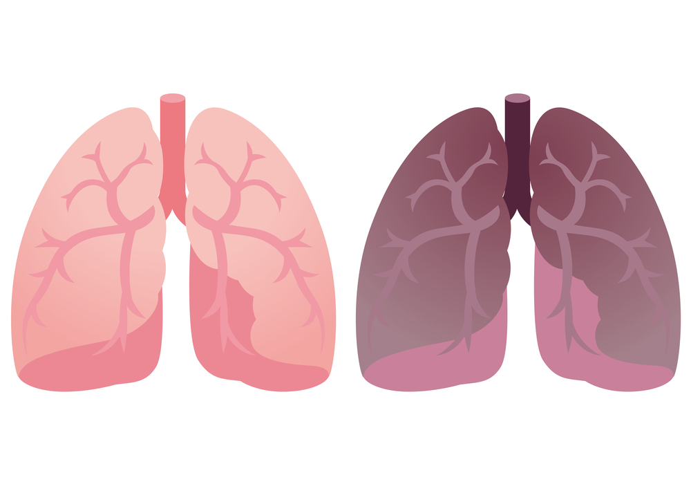 Study Finds IPF Patients Should Continue Pirfenidone Use Even as ...