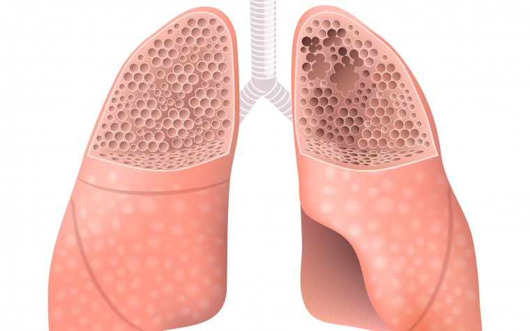 Vapor ablation for emphysema