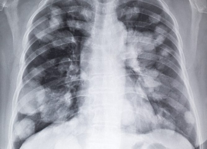 Solithromycin for Community Acquired Pneumonia Shows Positive Phase 2 Results