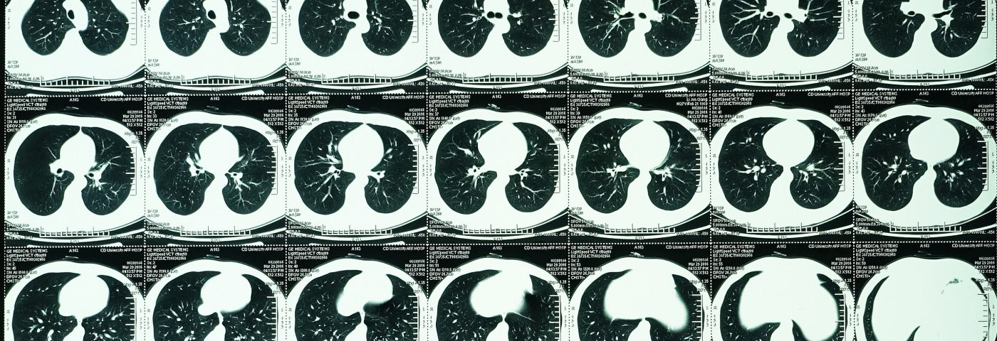 Annual CT Scans as Good as Biopsies for Determining Cancer Risk of Lung Nodules, Study Says