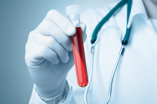 Blood Test Seen to Predict Chemotherapy Response in Advanced Lung Cancer Patients