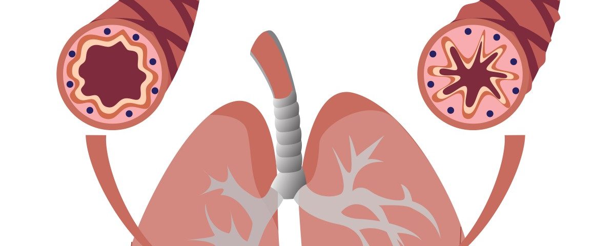 HMGB1 Protein Causes Lung Airways of People with Severe Asthma to Narrow, EU Study Finds