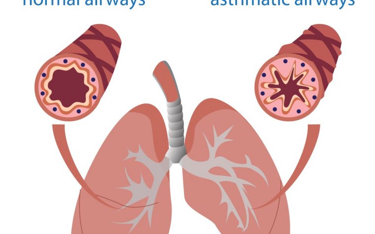 asthma pathology