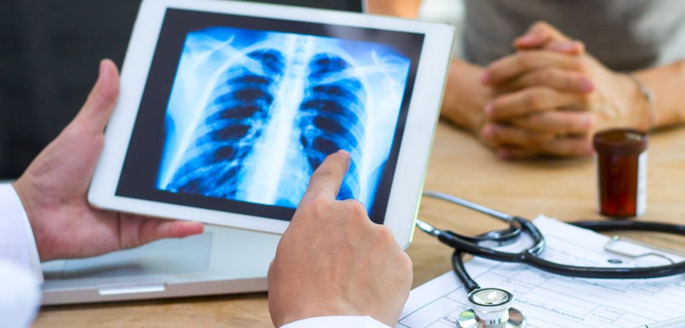 Aggressive Surgery Increases Lung Cancer Patients’ Long-term Survival, Study Shows