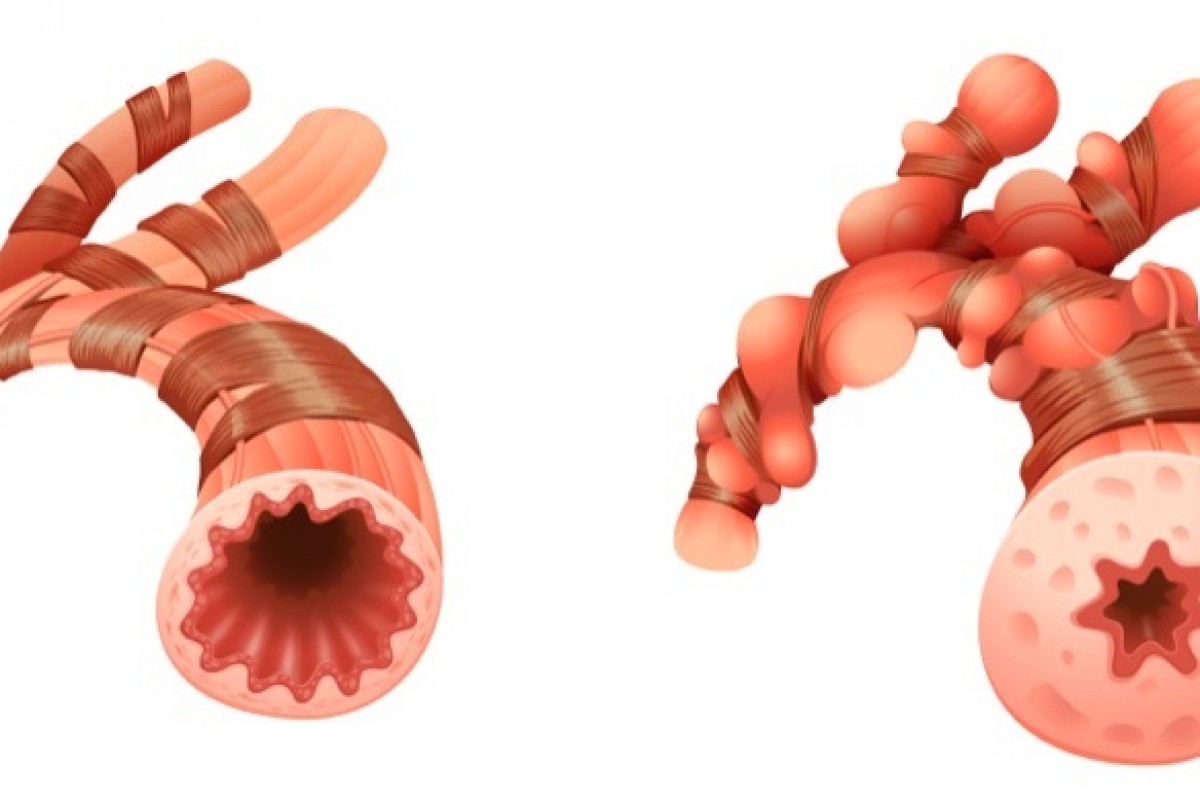 New Observations Made in Asthma-COPD Overlap Syndrome (ACOS) Patients